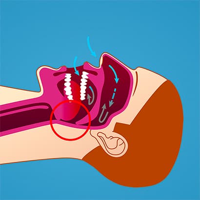 Ved søvnapné vil tungen og musklene i svelget avspennes i den grad at luftveiene blokkeres. Vi i Oris Dental kan hjelpe deg med behandling av søvnapné.
