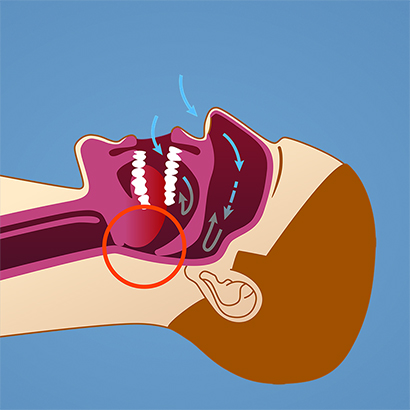Ved søvnapné vil tungen og musklene i svelget avspennes i den grad at luftveiene blokkeres. Vi i Oris Dental kan hjelpe deg med behandling av søvnapné.